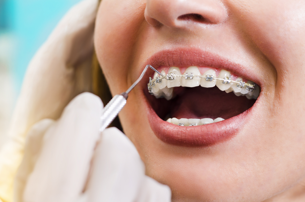 How To Save Money with dental implant center in Dwarka?