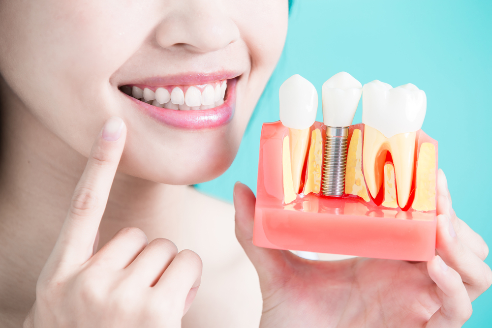 Dental implants