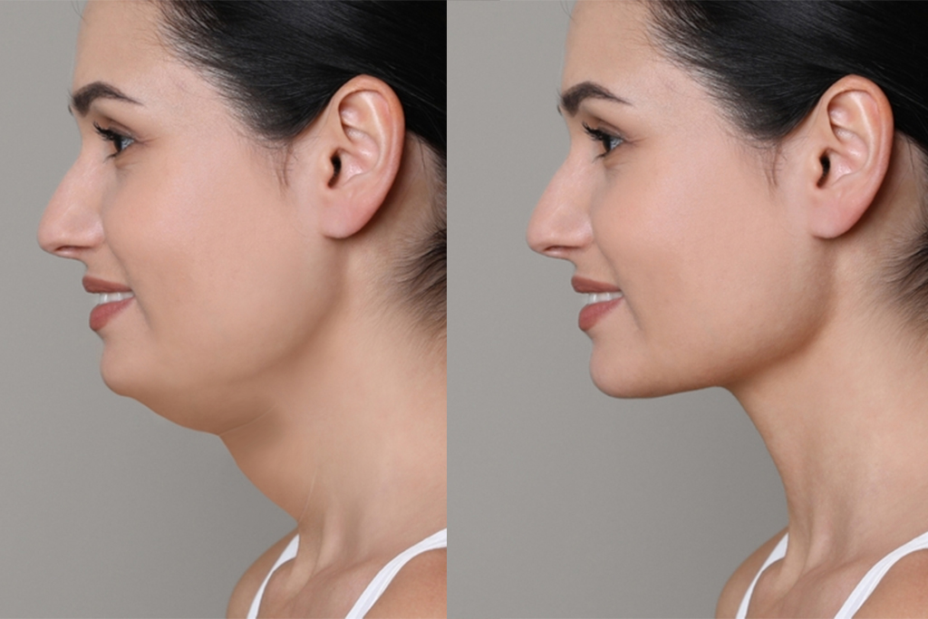 Double Chin Treatment Aarogya Dental N Skin