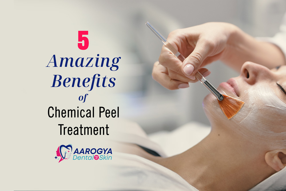 5 Amazing Benefits of Chemical Peel Treatment